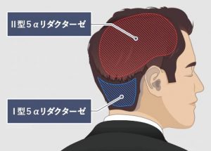【AGA治療】5α(アルファ)リダクターゼ！AGAは頭髪のシロアリ。